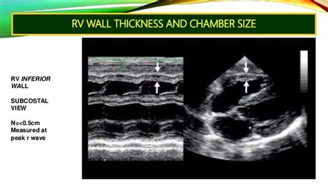 rv free wall thickness